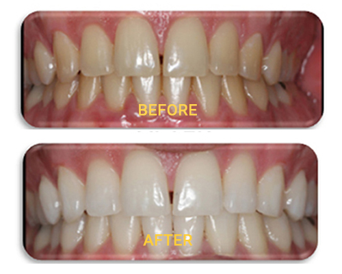 Bleaching (Advanced Tooth Whitening)