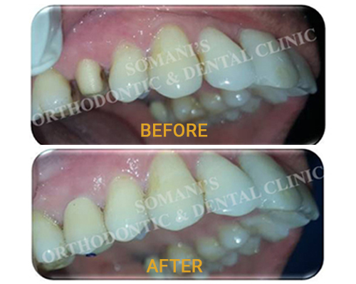 Crown and Bridge (Replacement Of Missing Teeth)