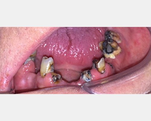 maxillofacial prosthodontics