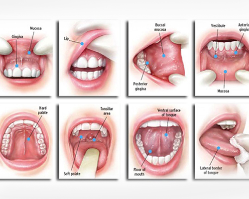 treatment of oral cancers