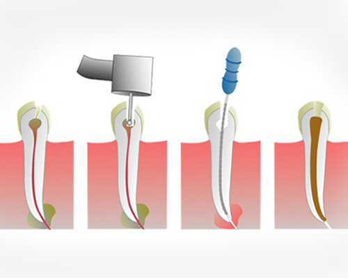 Painless Single Sitting Root Canal Treatment