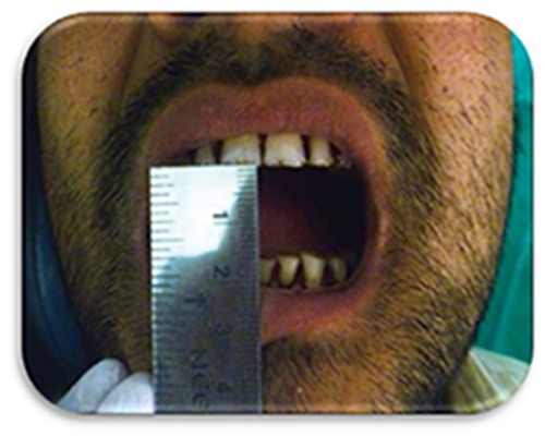 treatment of reduced mouth opening
