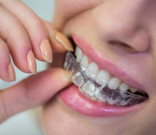 Diamond Invisalign