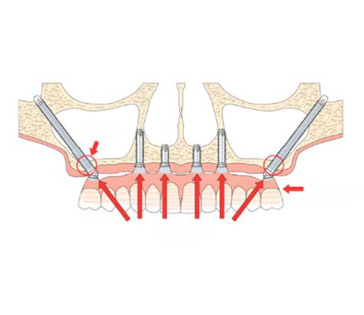 Zygomatic Dental Implants