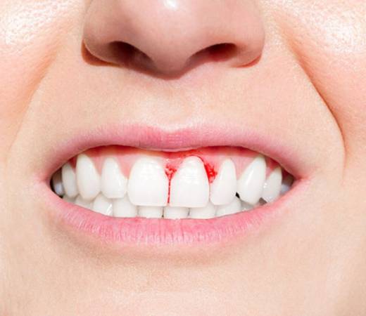 Bleeding Gums