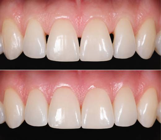 Black Triangle Treatment