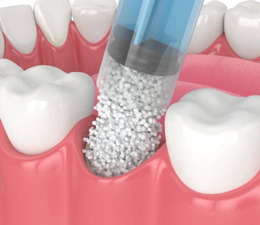 Dental Bone Grafting