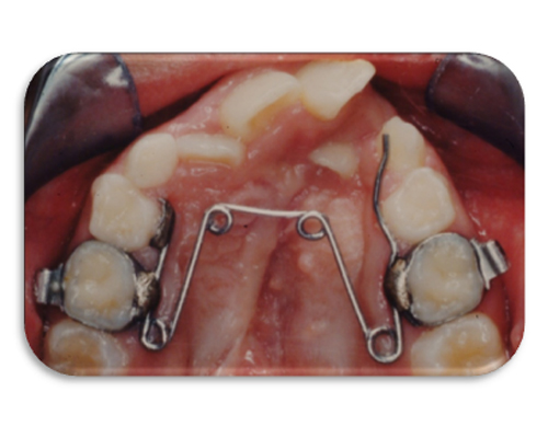 Cleft Lip And Palate Orthodontics