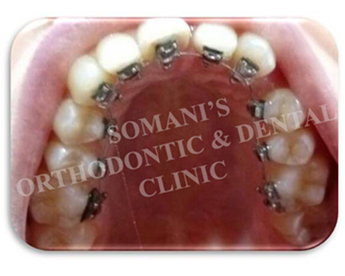 Lingual Braces