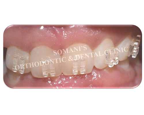 Ceramic Braces
