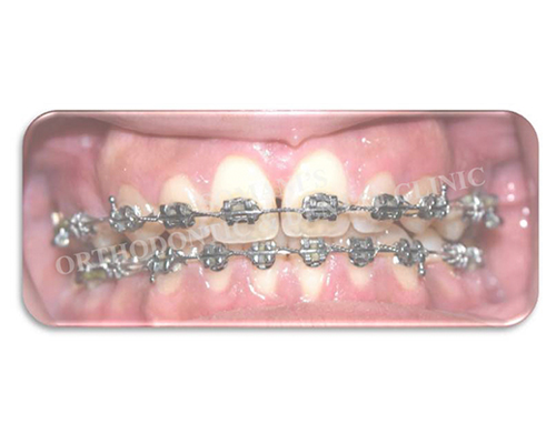 Metal Braces