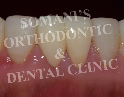 orthodontic treatment in ahmedabad