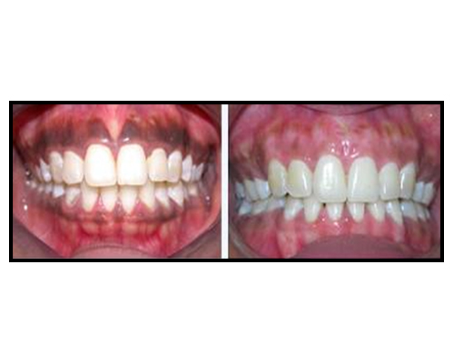 dental depigmentation before after