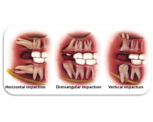Removal Of Wisdom Teeth (Disimpaction)